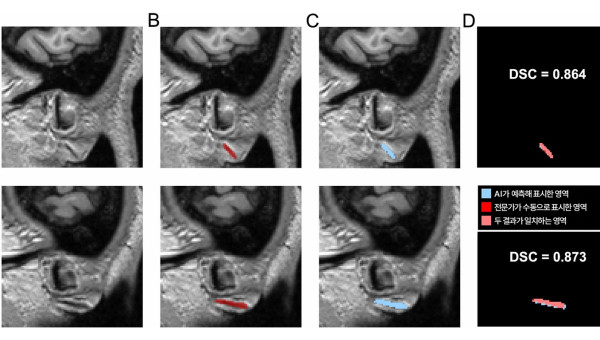 귓불에 주름 있다면?…“뇌혈관 손상 신호일 수 있어”