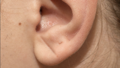 귓불에 주름 있다면?…“뇌혈관 손상 신호일 수 있어”